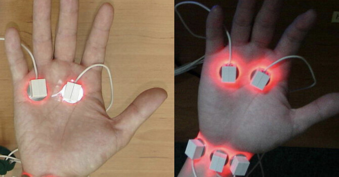 Laser Acupuncture